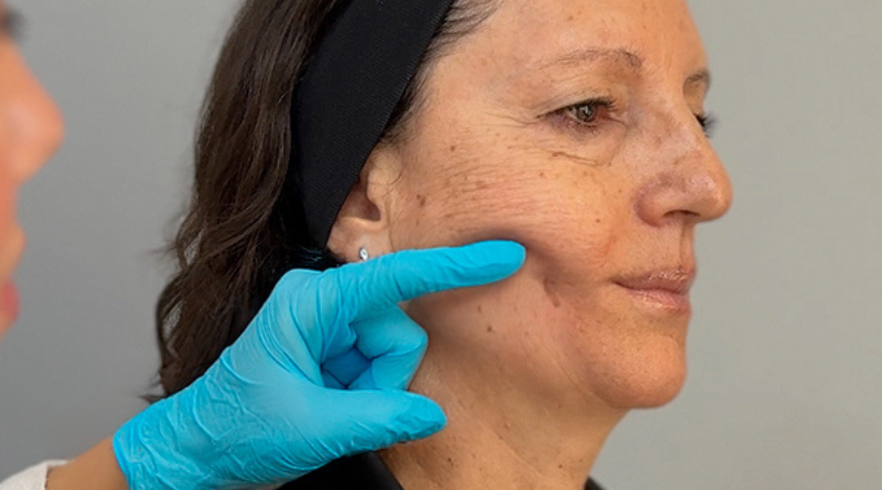 5 señales poderosas de que Sculptra es tu mejor elección