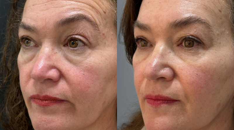 antes y despues sculptra