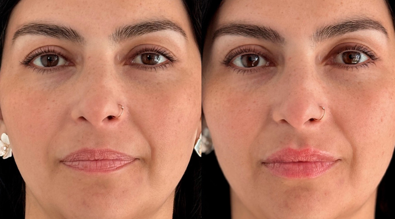 antes y después RHA kiss