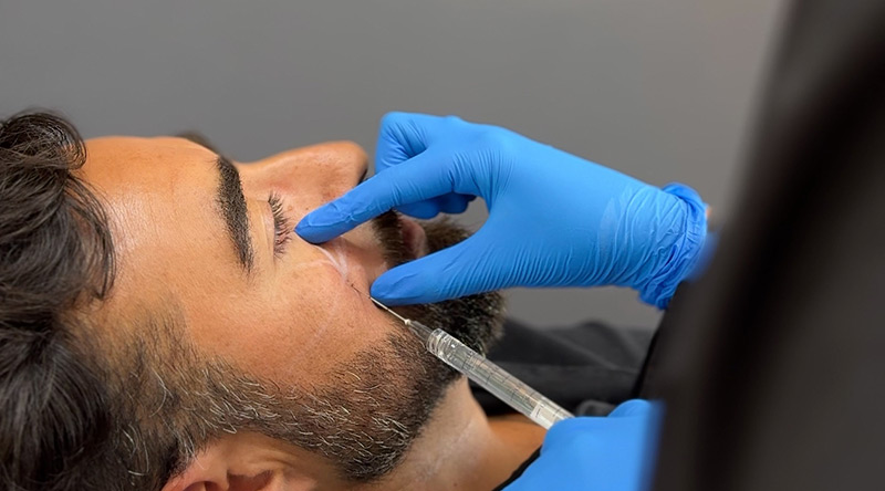 Ácido Hialurónico Beneficios y Usos en Estética Facial