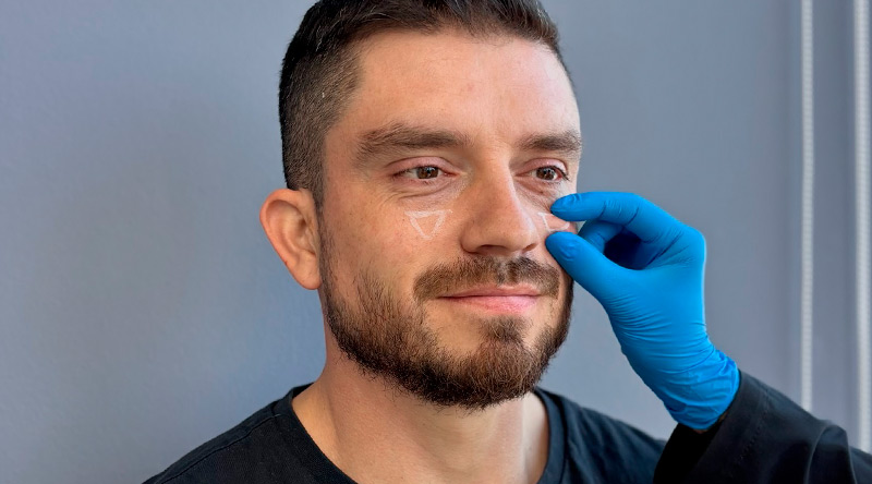 Ácido Hialurónico Rellenos Faciales Naturales y Seguros