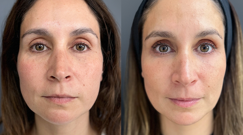 antes y después bioestimulador radiesse