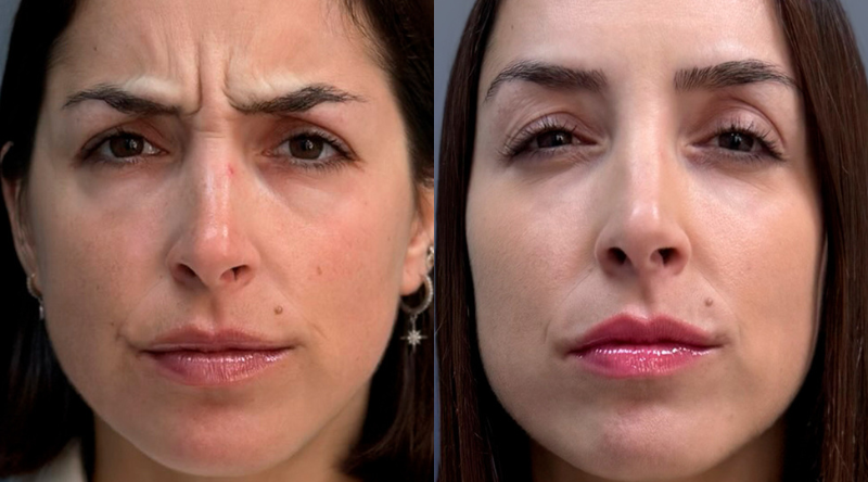 Aplicación de Botox facial en zona del entrecejo por doctor certificado.