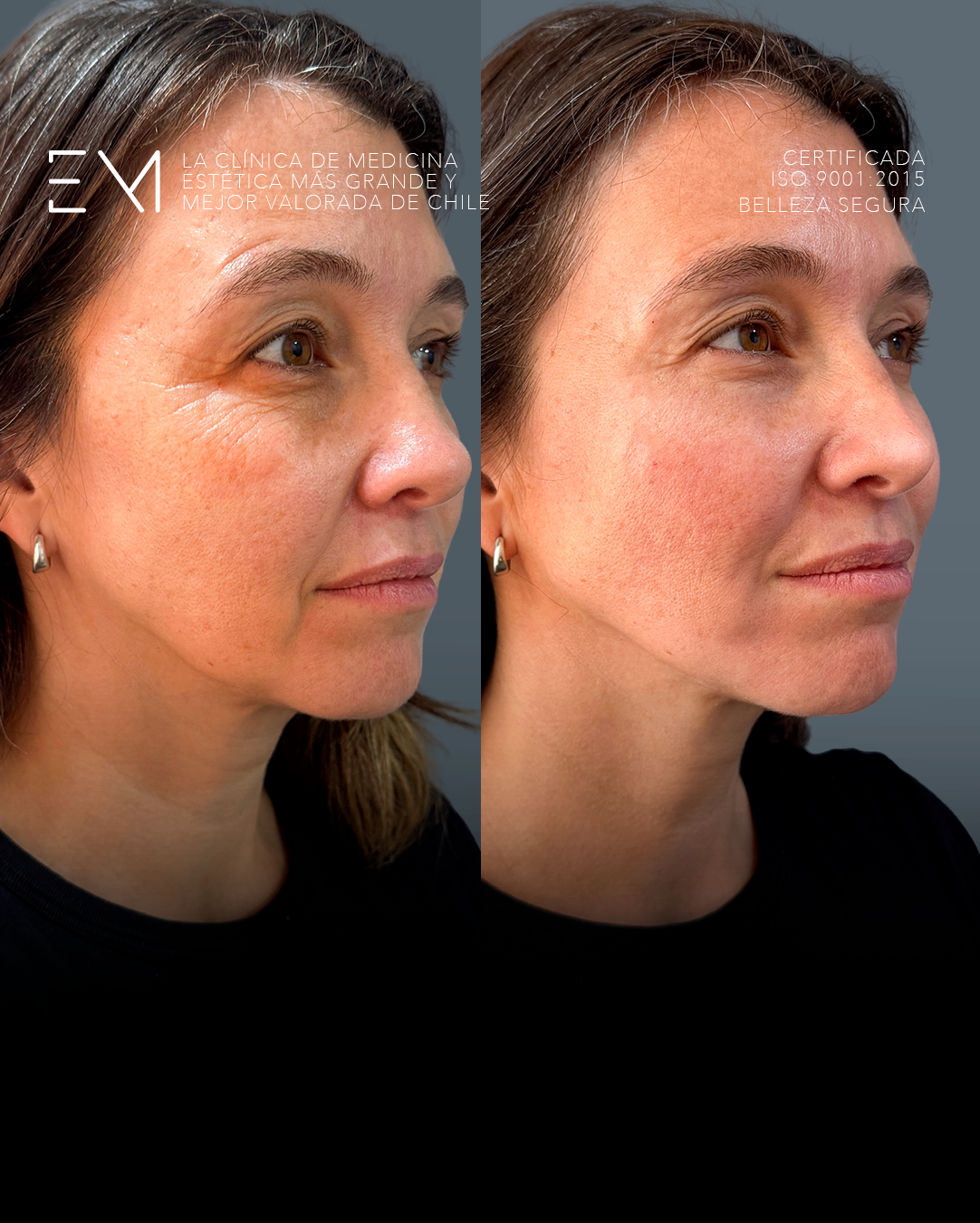 longlasting resultado antes y despues