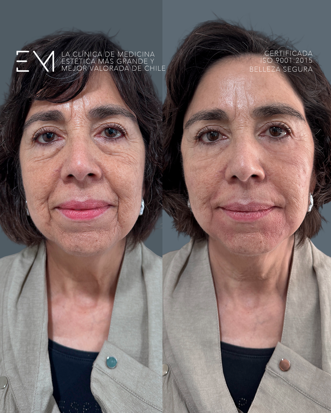 resultado sculptra antes y despues