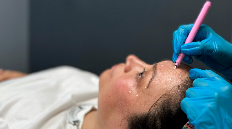 Botox Cyber 2025 descubre antes y después en Clínica EM