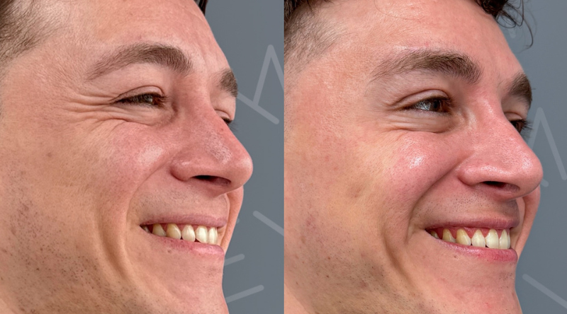 Ofertas Cyber en Clínica EM botox antes y despues