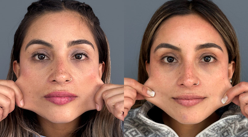 Pilla antes y después en Clínica EM