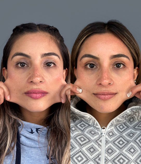 resultado sculptra antes y despues