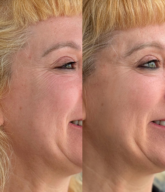 Botox frente chile