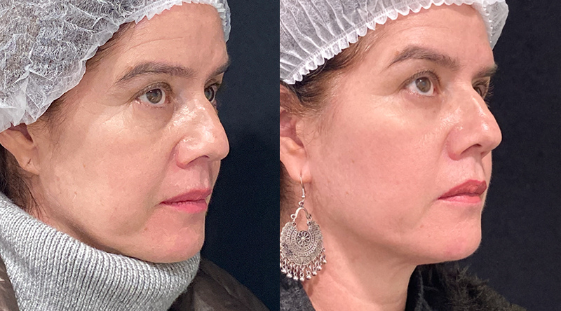 Radiesse Cyber antes y después del tratamiento facial.