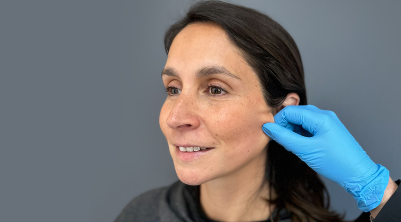 Radiesse Cyber aplicado por especialista en rejuvenecimiento facial.