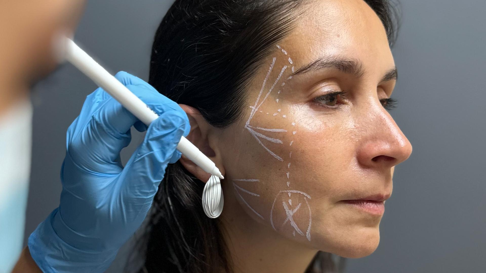 Radiesse: Rejuvenecimiento Facial Seguro y Eficaz