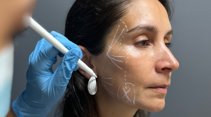 Rejuvenecimiento Facial con Radiesse: Resultados Naturales y Duraderos