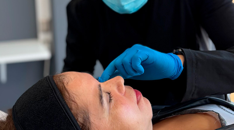 Relleno de Ojeras 2025: Guía Efectiva con Ácido Hialurónico