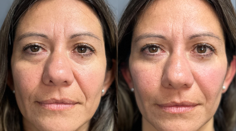 Relleno de Pómulos Black Friday 2025 | antes y después