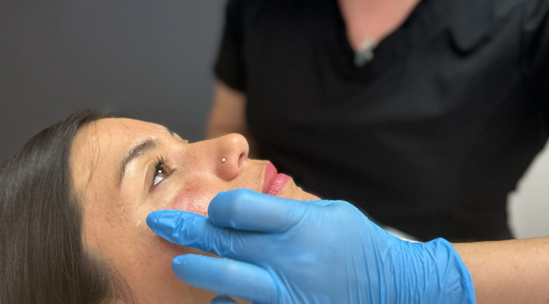 Relleno de Pómulos Black Friday 2025 | tratamiento