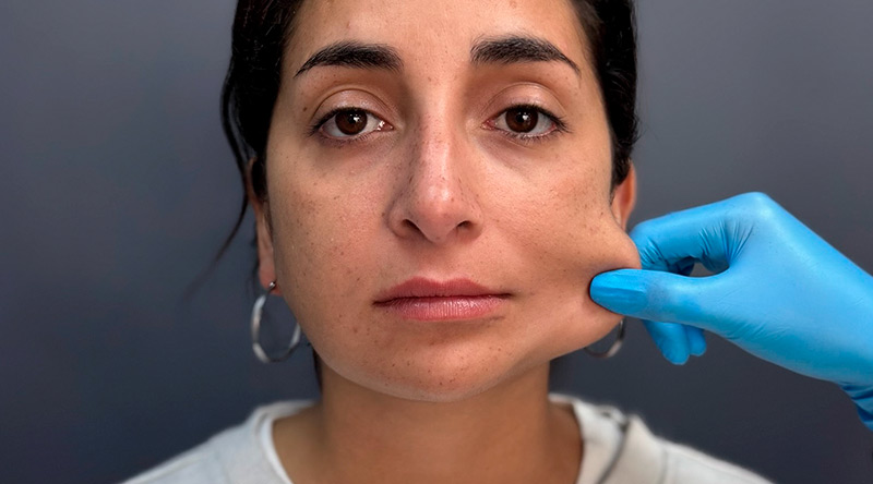 Resultados naturales con Pilla en Clínica EM