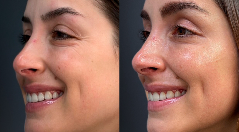 Tratamiento antiarrugas con toxina botulínica realizado en Clínica Estétika Médica.