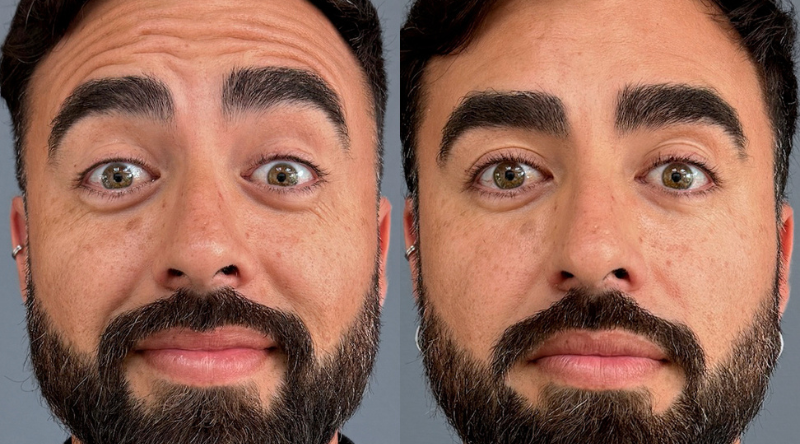 toxina week botox antes y después hombre