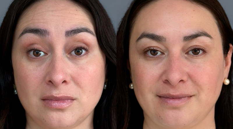 botox antes y despues toxina week mujer