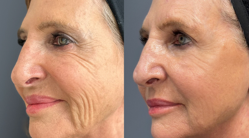 antes y después sculptra