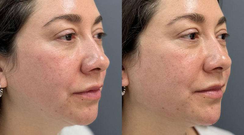 antes y después Relleno de mentón Black Friday