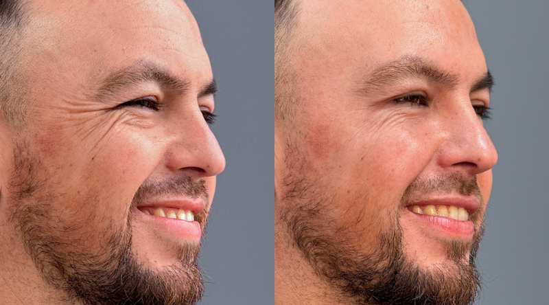 antes y despues botox hombre