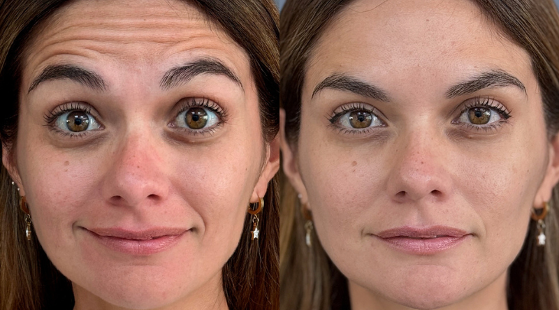 antes y después botox preventivo