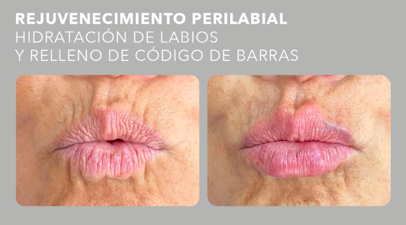 antes y después perilabial