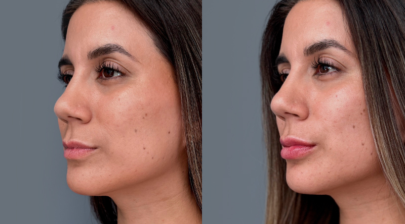 antes y despues relleno de labios natural clinica em