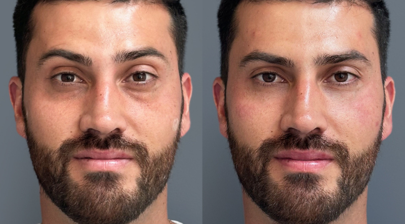 Resultado relleno de ojeras en un hombre