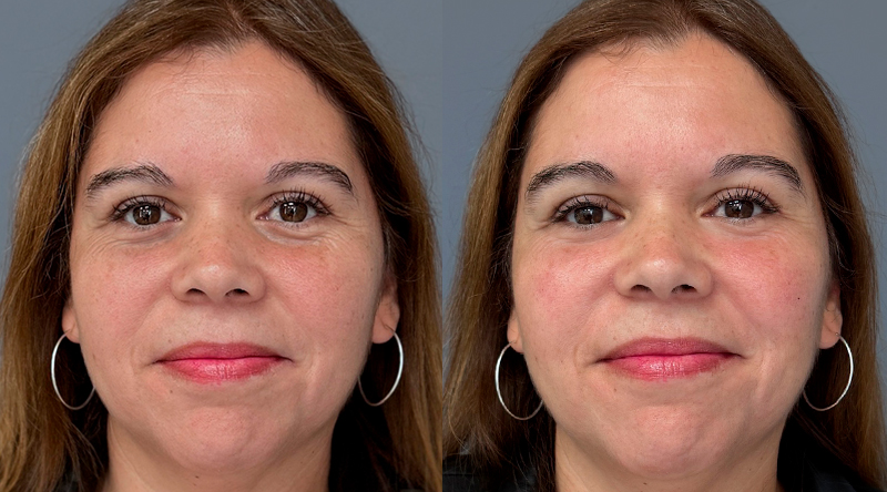 Antes y después relleno de ojeras ácido hialurónico