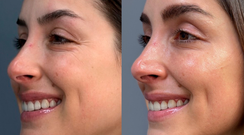 botox antes y despues patas gallo