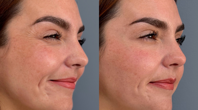botox antes y despues mujer