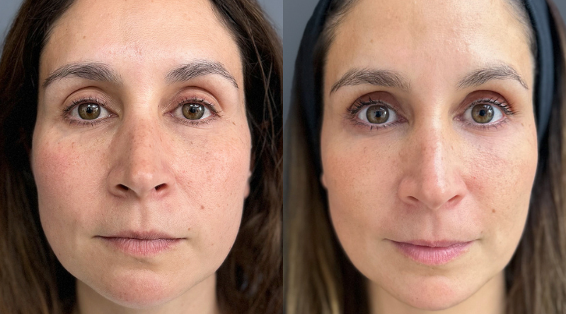 cyber estetica facial bioestimuladores colageno