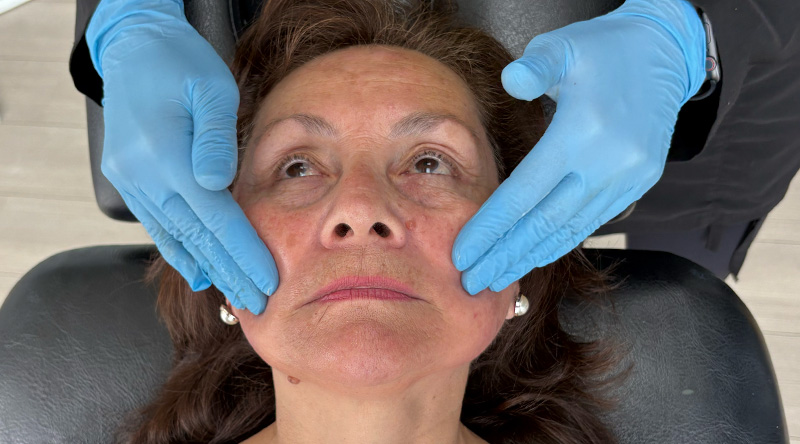 masaje bioestimulador después de aplicar Pilla protocolo 5x3x5 y sculptra 5x5x5