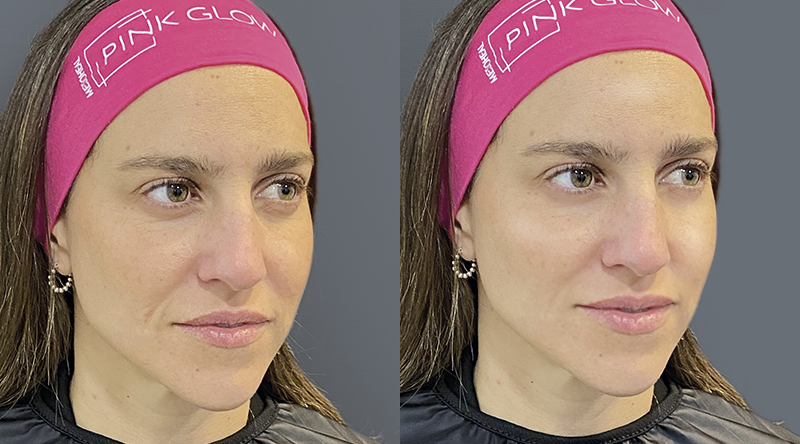 mesoterapia pink glow antes y despues