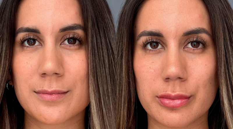 procedimiento seguro de relleno de labios con ácido hialurónico