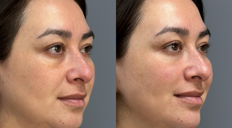 antes y despues Relleno de Mentón en Oferta Armonización Facial 2025