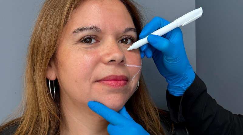 relleno de ojeras con resultados naturales