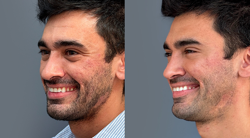 antes y después relleno malar
