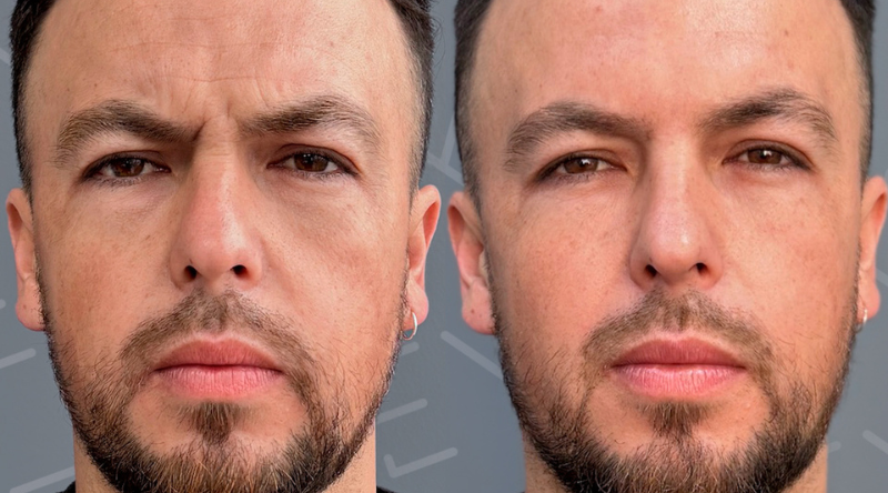 resultados antes y después de botox