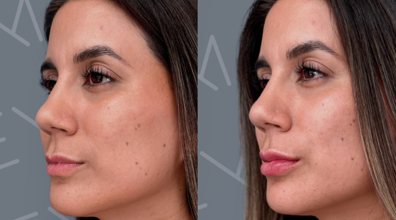 resultados antes y después relleno de labios con ácido hialurónico