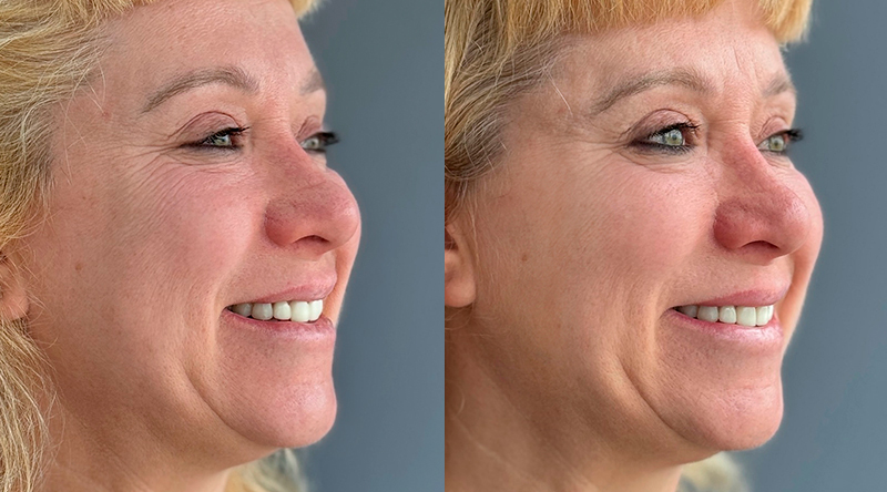 resultados naturales con NucleoFill Strong.