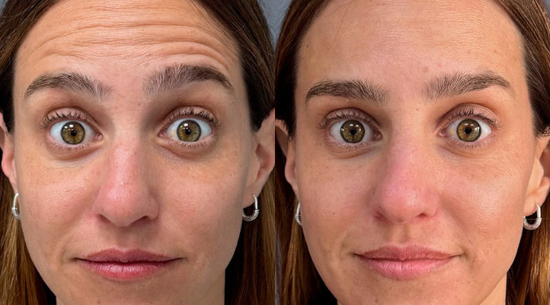 resultados toxina botulinica frente clinica em