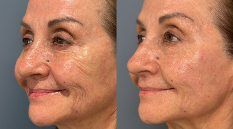 skinvive antes y despues