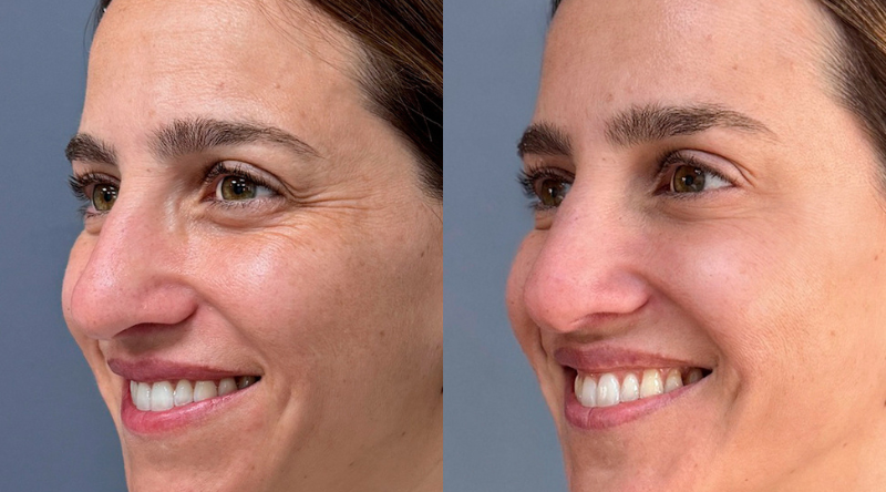 toxina botulinica antes y despues mujer