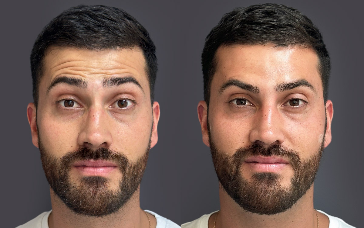 toxina botulinica antes y después