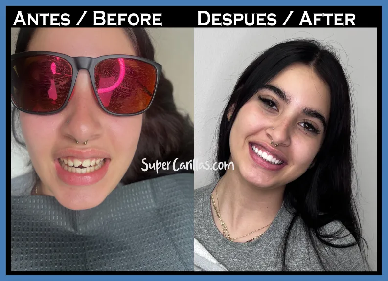 Porcelain veneers in Miami | SuperCarillas Porcelain veneers in Miami - Before and after